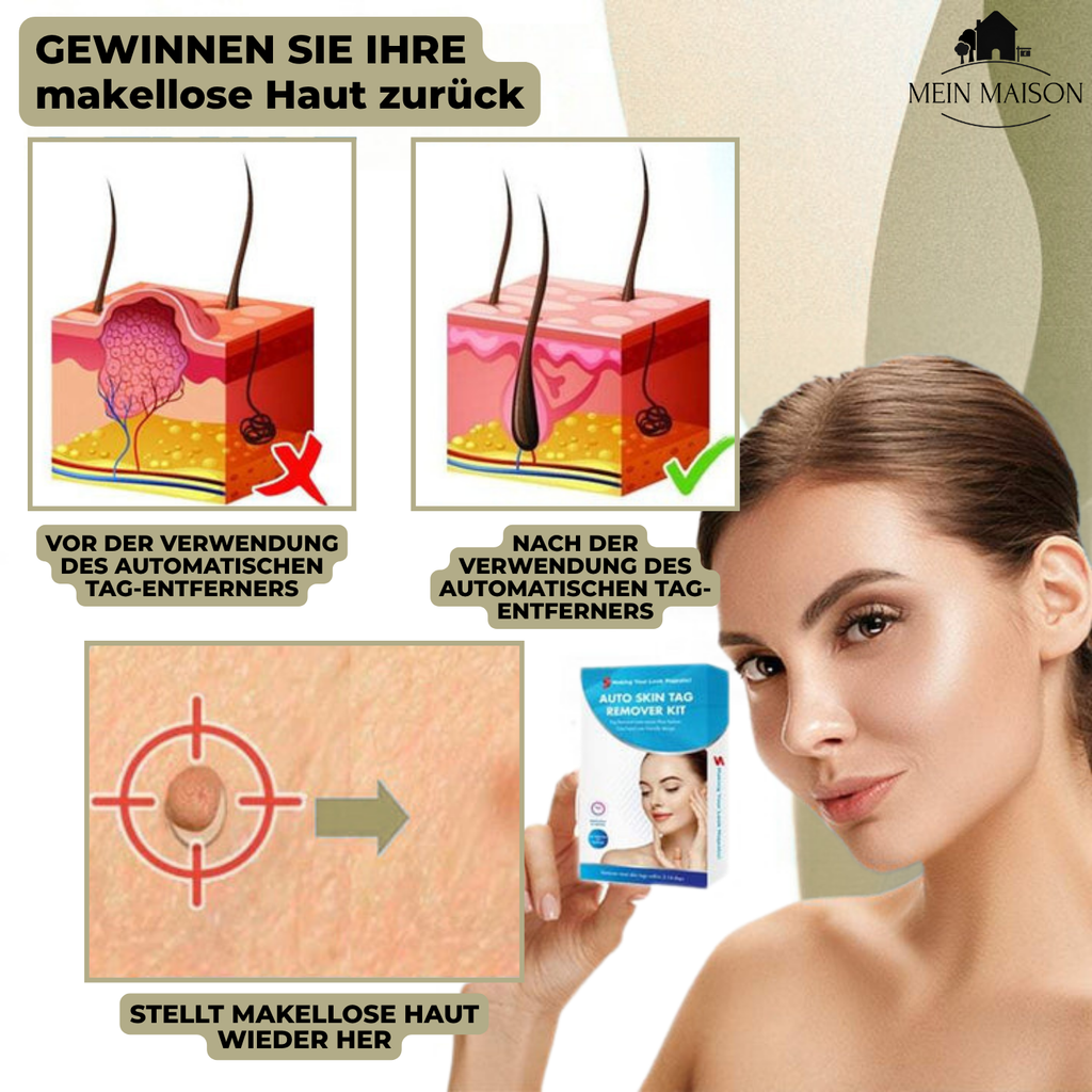 DermaLinx Wart Remover for Home Use