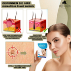 DermaLinx Wart Remover for Home Use