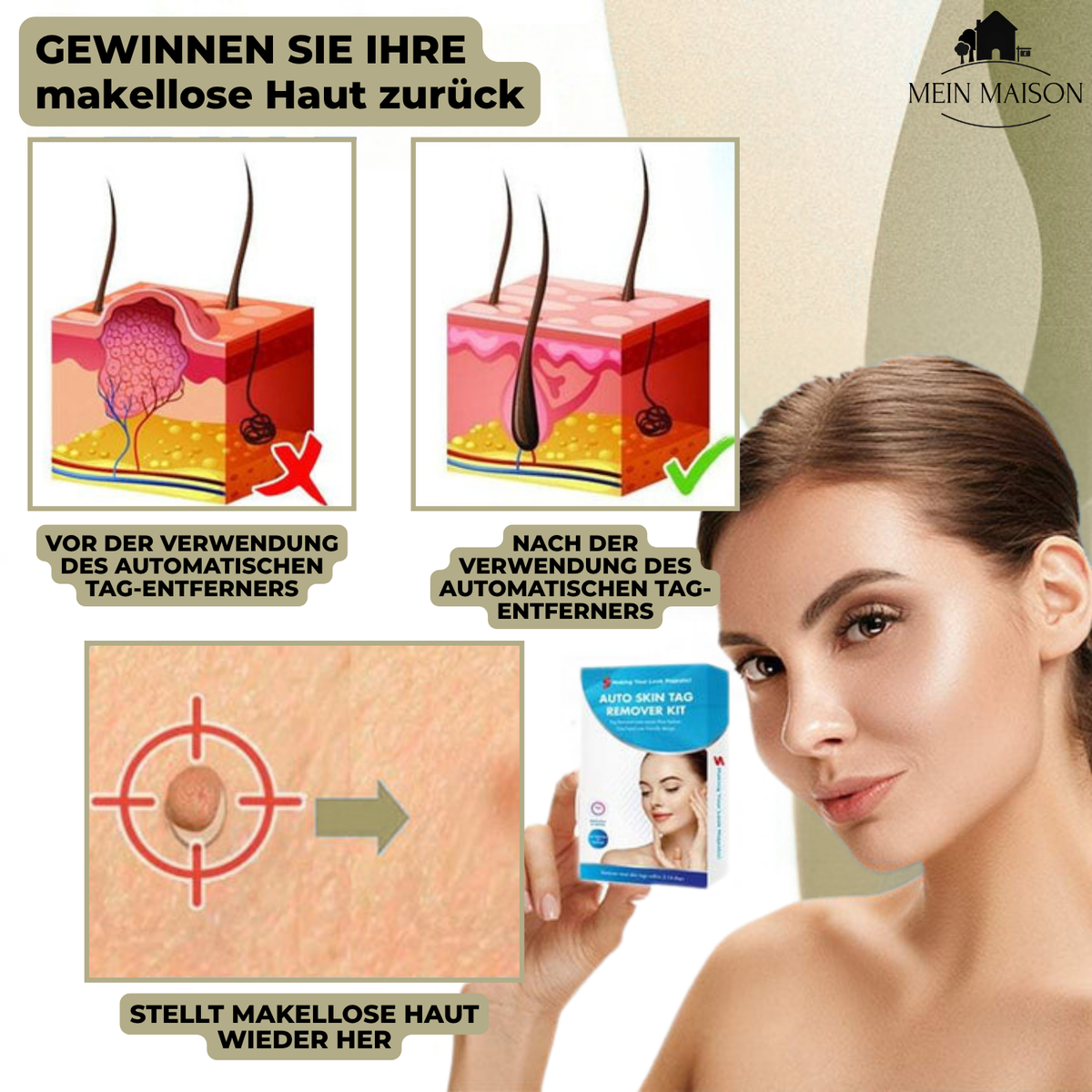 DermaLinx Wart Remover for Home Use