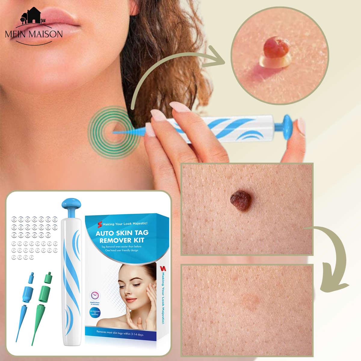 DermaLinx Wart Remover for Home Use