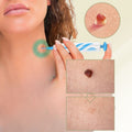 DermaLinx Wart Remover for Home Use
