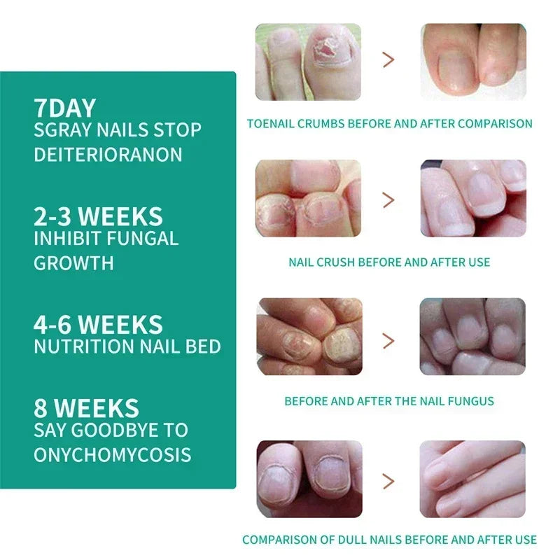 Nail Fungus Defender Serum - 10ml Nail Treatment, Repairs Damaged Nails, view 10