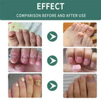 Nail Fungus Defender Serum - 10ml Nail Treatment, Repairs Damaged Nails, view 4