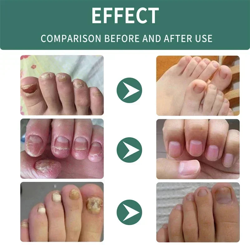Nail Fungus Defender Serum - 10ml Nail Treatment, Repairs Damaged Nails, view 4