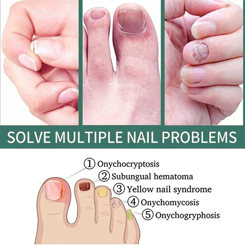Nail Fungus Defender Serum - 10ml Nail Treatment, Repairs Damaged Nails, view 5