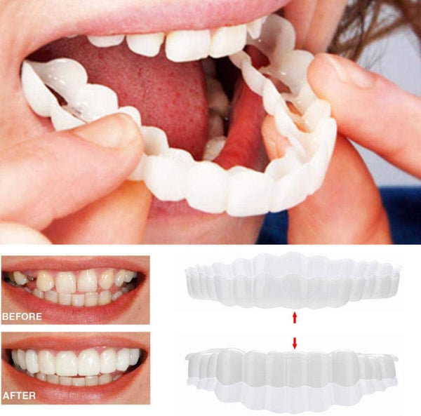 Removable Snap-On Veneers for Upper and Lower Jaw, Acrylic Resin Set