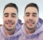 Removable Snap-On Veneers for Upper and Lower Jaw, Acrylic Resin Set