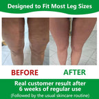 Sakerplus Cellulite Massage Roller with Adjustable Opening